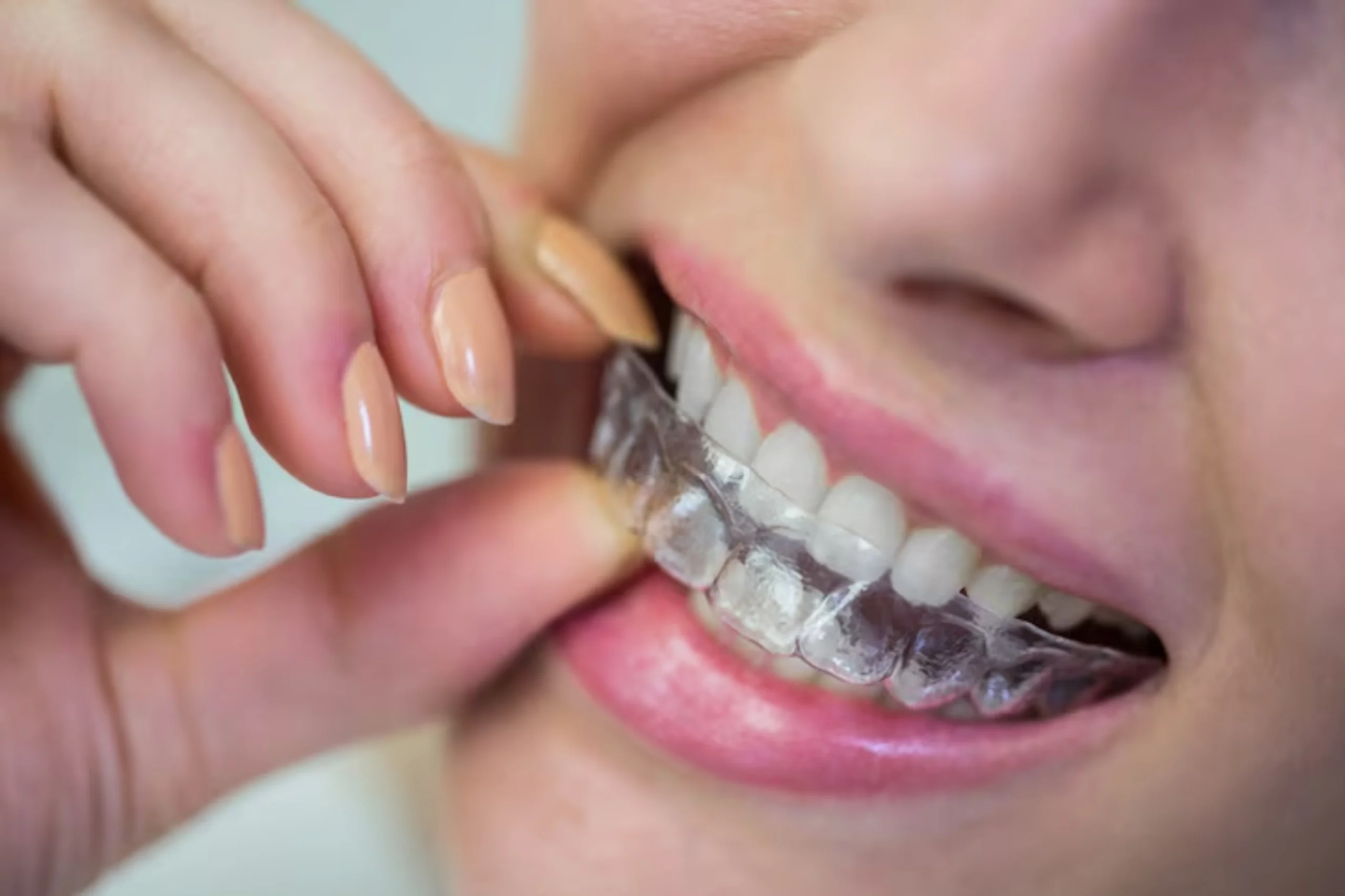 Do Clear Aligners Fix Overbite and Improve Your Smile? 