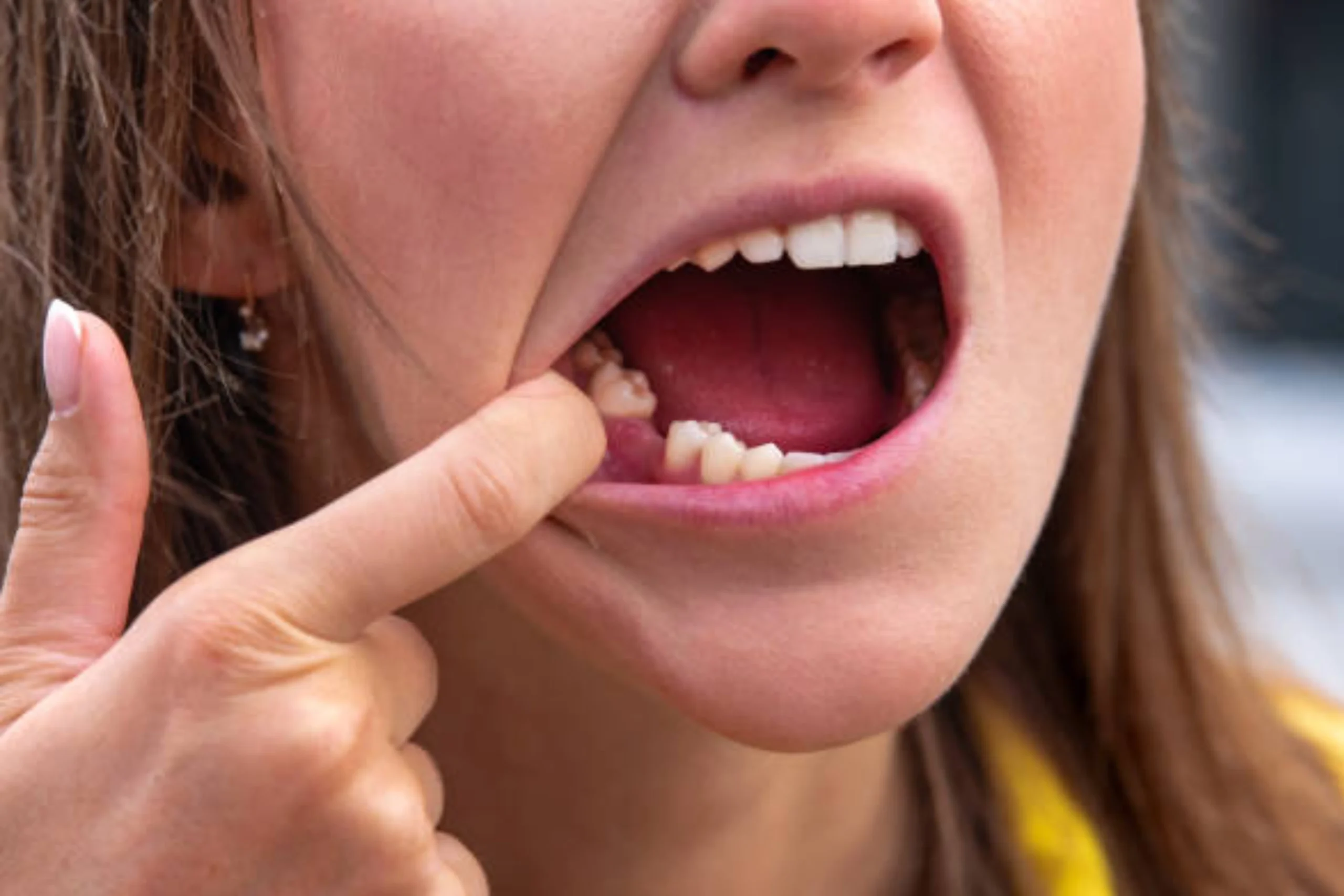 Dental Replacement Options After Losing a Tooth: Which One Is Right for You?
