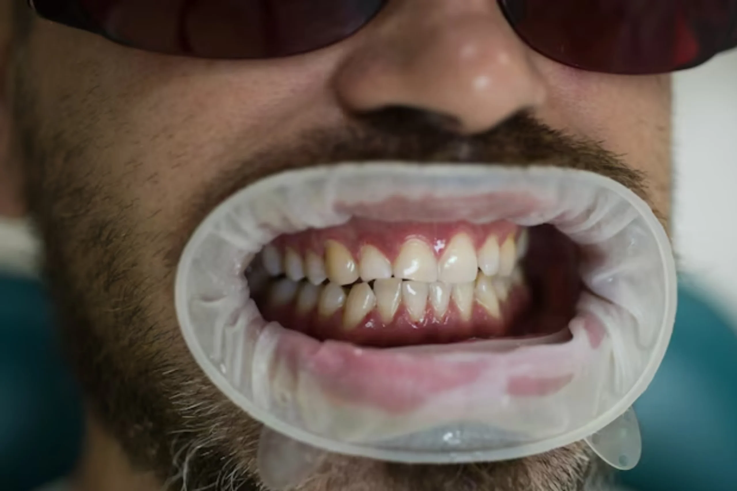 Dental Tartar vs Plaque: What’s the Difference?
